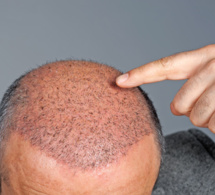 Greffe de cheveux : rester en France ou partir en Turquie ?