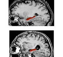 Alzheimer : arrivée d’un logiciel pour mieux diagnostiquer la maladie