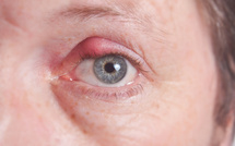 5 questions autour du chalazion et de son opération