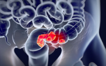 Cancer colorectal : des kits de dépistage disponibles en pharmacie