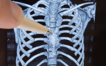 Autriche : première pose d'un implant sternal en céramique sur une patiente septuagénaire