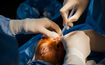 Blépharoplastie : une nouvelle technique sans chirurgie grâce au laser CO2