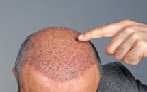 Greffe de cheveux : rester en France ou partir en Turquie ?