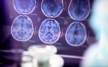 2024 : 4 millions d'euros pour faire avancer la recherche sur Alzheimer