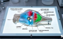 Arthrose guérie par injection en huit semaines : pourquoi votre rhumatologue n'en parle pas