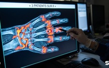 Huit traitements avaient échoué en dix ans sur leur polyarthrite : une perfusion de cellules a suffi, et trois malades ont rangé leurs injections